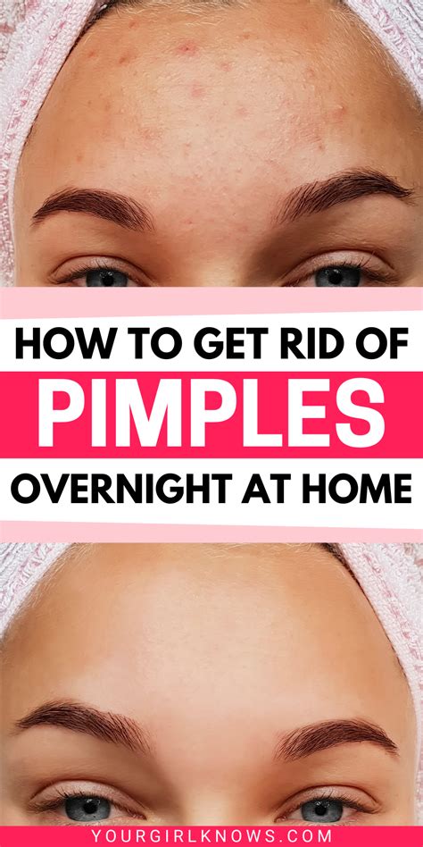 How To Get Rid Of Pimples Overnight At Home Diy Acne Treatments Yourgirlknows How To Get