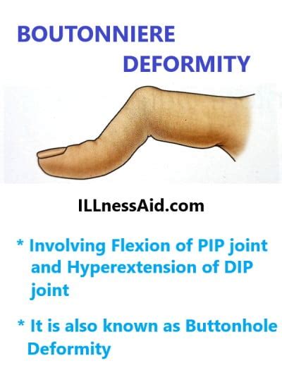 BOUTONNIERE DEFORMITY EXERCISES Archives - ILLnessAid