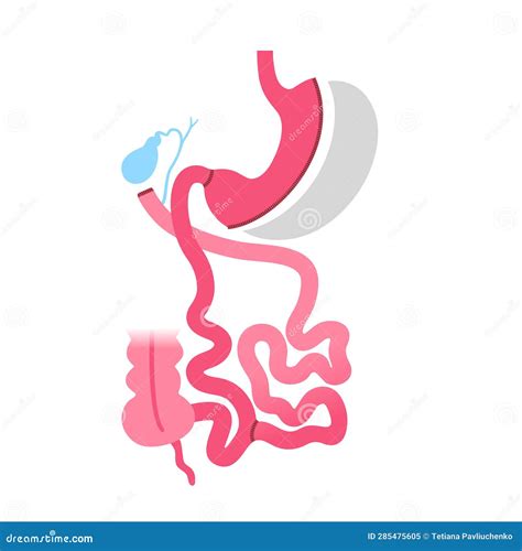 Biliopancreatic Diversion Procedure Stock Vector Illustration Of