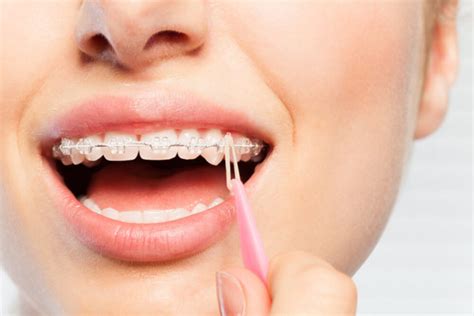 Elásticos intermaxilares uso en ortodoncia Adeslas Dental