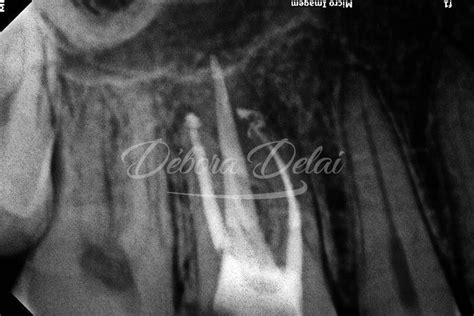 Casos Clínicos Retratamento Endodôntico Com Manejo De Instrumento
