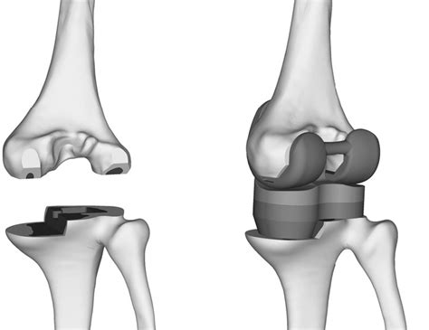 The FE model of the total knee arthroplasty. Left: the resurfaces of ...