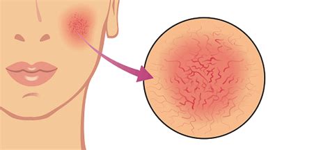 Przyczyny Tr Dziku R Owatego Portal Dermatologiczny