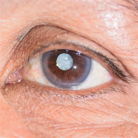 Traumatic Cataract