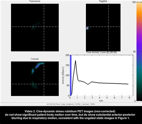 Data Driven Motion Correction Rescues Interpretation Of Rubidium Pet