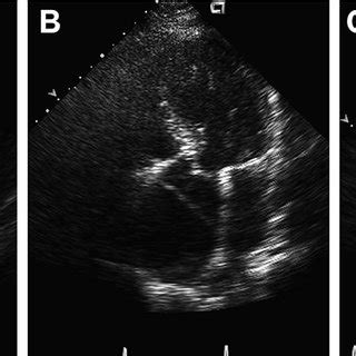 Transthoracic echocardiogram of a bicuspid aortic valve with severe... | Download Scientific Diagram