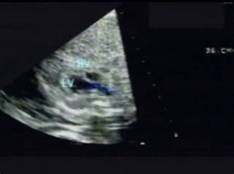 Aortic Valve Incompetence Ultrasoundpaedia