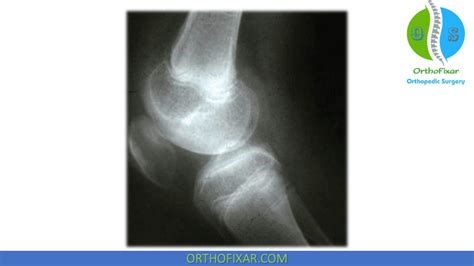 Knee Arthrofibrosis Orthofixar