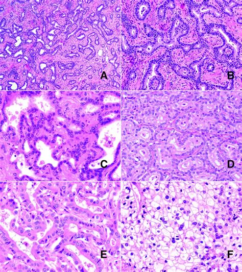 Cholangiocarcinoma Histology