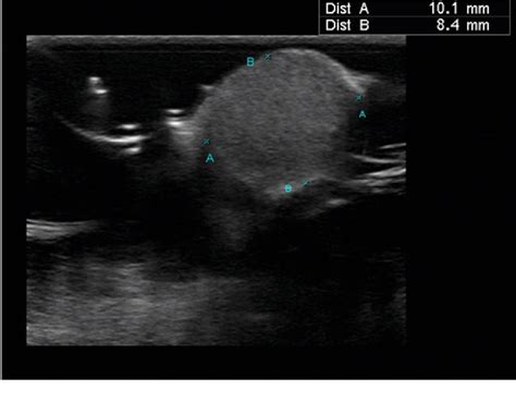 Figure 2 From Dermoid Cyst Of Nasal Tip With A Sinus Tract Extending To