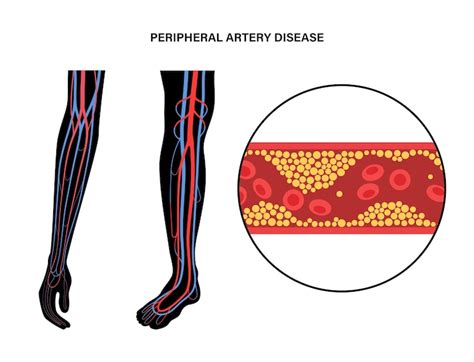 Premium Vector Peripheral Artery Disease