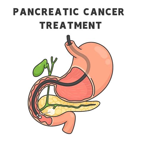 Premium Vector | Pancreatic cancer treatment chart in science subject kawaii doodle vector cartoon