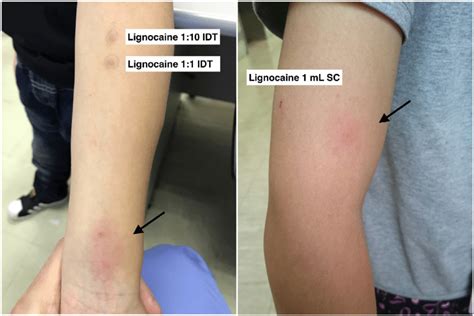 Diffuse Erythematous Pruritic Non Urticarial Rash Located At And Download Scientific Diagram