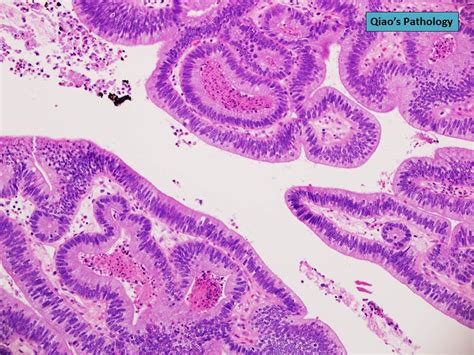 Qiao S Pathology Papillary Adenoma Of The Gallbladder Intracystic