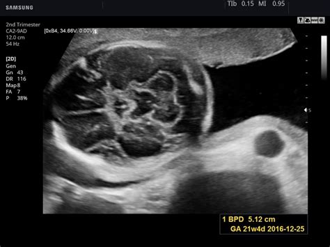 Normal Fetal Brain Ultrasound