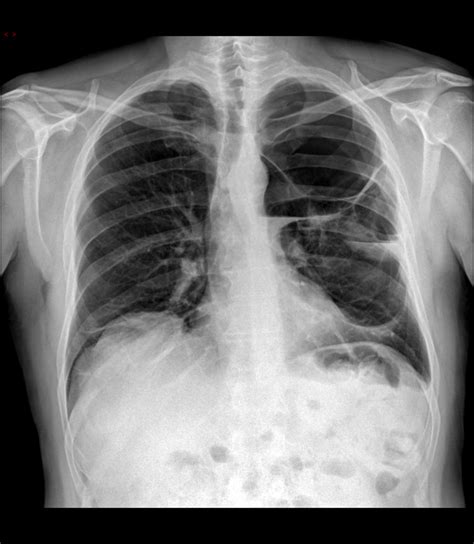 Air Fluid Levels Within An Emphysematous Giant Bullae Eurorad