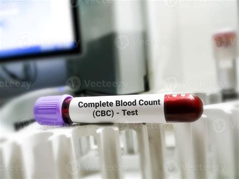 Blood Sample For Cbc Or Complete Blood Count Test Hematological