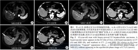 基于2018版肝脏影像报告及数据系统评估CT及MRI诊断3cm肝细胞癌 哔哩哔哩