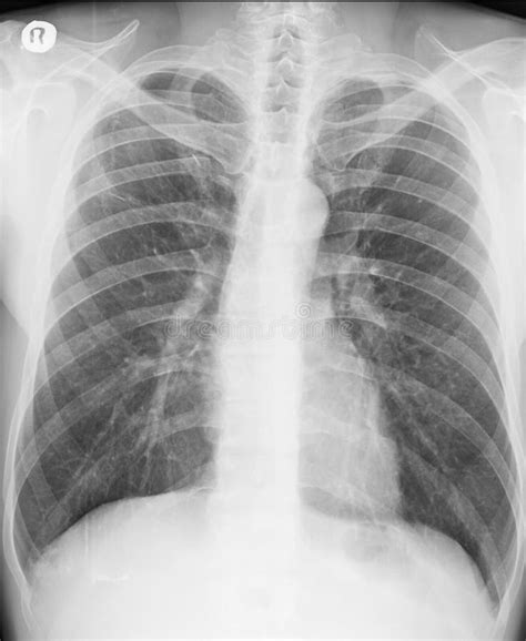 Pneumothorax Chest X Ray