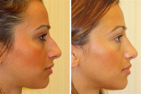 Rhinoplasty Nose Surgery Nose Job For Women In New York City David