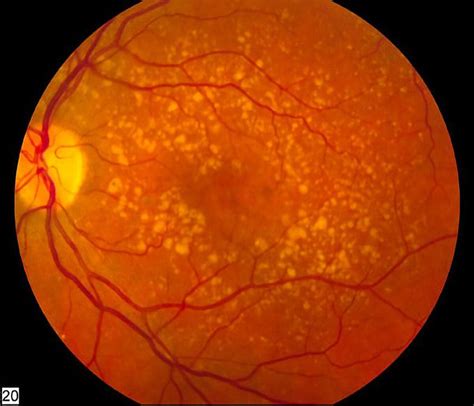 What Causes Macular Degeneration Medizzy