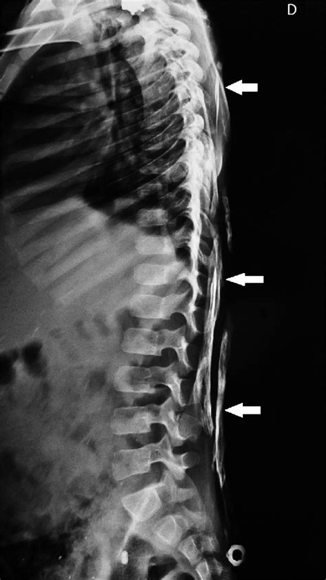 Radiograph Showing Heterotopic Ossification Over Abdomen And Thoracic Download Scientific