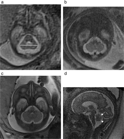 Diagnostic Imaging Of Posterior Fossa Anomalies In The Fetus And