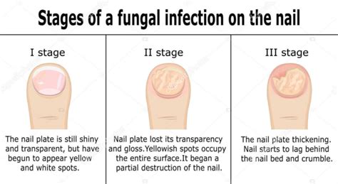 Amazing Home Remedies To Treat Nail Fungus Nailcon