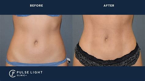 Vaser Liposuction Vaser Liposuction London Pulse Light Clinic