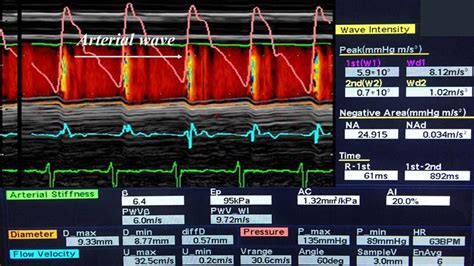 Echo Tracking Principle Used To Measure Pulse Wave Velocity Pwv Download Scientific Diagram