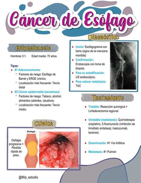 Cáncer de Esófago Mip estudio uDocz