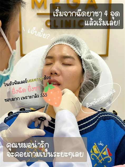 ฉีดฟิลเลอร์ปากครั้งแรก💋💉 รีวิวละเอียดยิบ แกลเลอรีที่โพสต์โดย