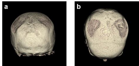 D Head Models Based On First Ct Images With Reconstruction By