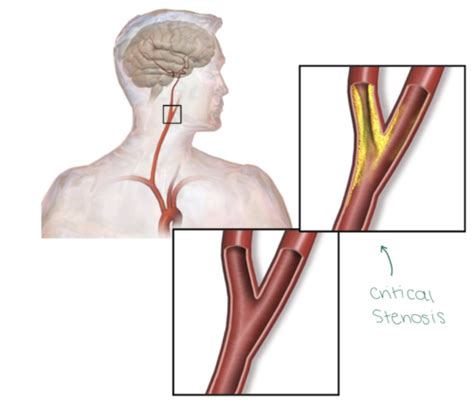 Cerebrovascular Diseases Flashcards Quizlet