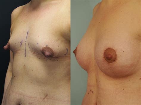 Lipofilling mammaire prix avis et photos de cette chirurgie à Paris