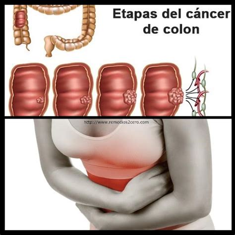 10 SEÑALES DE ADVERTENCIAS SOBRE EL CÁNCER DE COLON QUE USTED NO DEBE