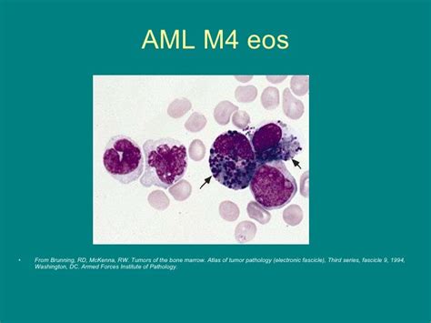 Acute Myeloid Leukemia