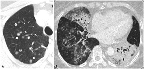 Prognosis For Pneumonic Type Invasive Mucinous Adenocarcinoma In A