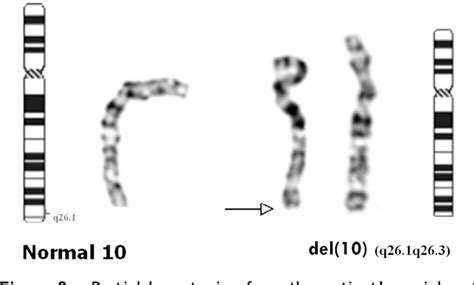 Figure 2 from Chromosome 10q deletion del (10)(q26.1q26.3) is ...