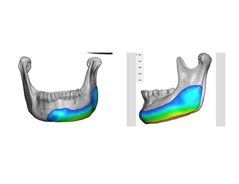 Plastic Surgery Case Study - Jaw Asymmetry Correction with Custom ...