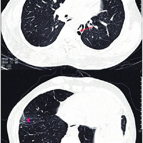 Chest Computed Tomography Shows Pneumatocele And Mild Bronchiectasis In