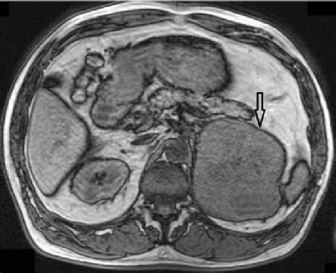 Figure 1 From The Usefulness Of Laparoscopic Adrenalectomy In The