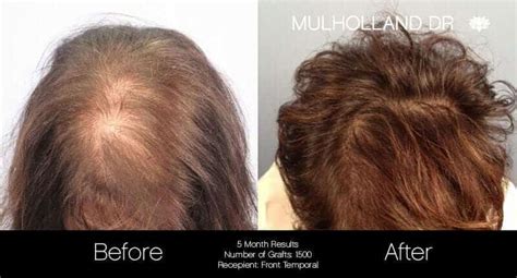 Female Hair Transplant Before & After Photo Gallery | TPS