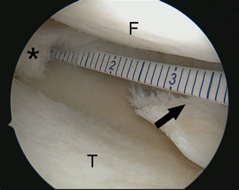 Minced Meniscus Biologic Augmented Meniscal Implant Treatment