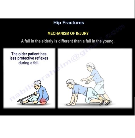 Hip Fractures Mechanism Of Injury OrthopaedicPrinciples