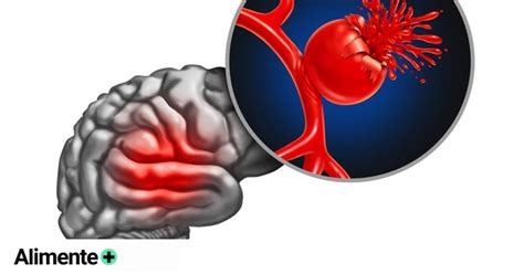 Una Neuróloga Explica Qué Es Un Ictus Y Las Señales Que Avisan De Que