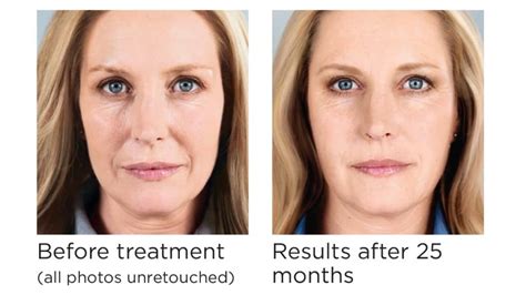 Nose wrinkles nasolabial injections Pittsburgh - Golla Center for ...