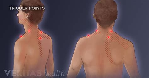 Trigger Point Exercises for Neck Pain