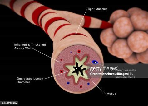 Inflamed Bronchial Tubes Photos And Premium High Res Pictures Getty