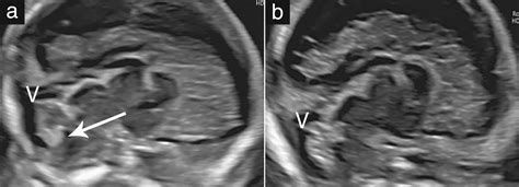 Position Of The Choroid Plexus Of The Fourth Ventricle In First‐ And Second‐trimester Fetuses A